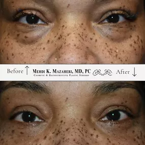 before and after lower blepharoplasty eye lift surgery in scottsdale