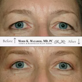 before and after blepharoplasty eye lift surgery in scottsdale