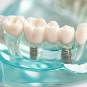 Vision Dental Studio is a full-service dental lab fully equipped with the expertise and technology to provide a comprehensive range of dental restoration and prosthetic services.