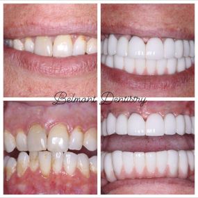 Full Mouth Extractions With Implant Placements At Belmont Dentistry Peoria