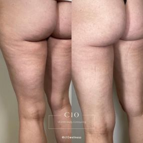 VFORM Body Contouring  at C10 Wellness in Miami-Dade