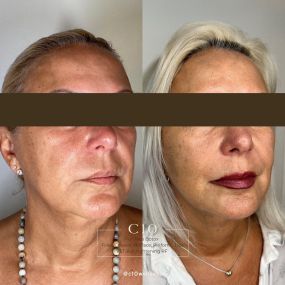 Botox, Filler and Skin Tightening done at C10 Wellness in Miami, FL