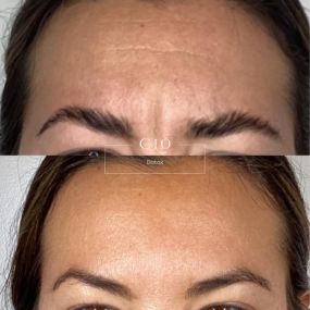 11S Botox done at C10 Wellness and Rejuvenation in Miami, FL