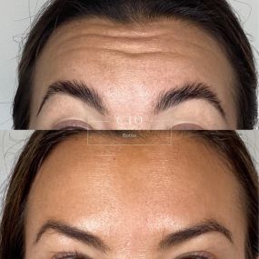 Forhead Wrinkle Treatment at C10 Wellness in Miami-Dade