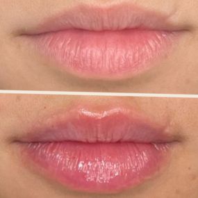 Plum Lips- Before and Afters by C10 Wellness and Rejuvenation in Miami