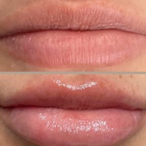 Lip Filler - Before and Afters by C10 Wellness and Rejuvenation in Miami