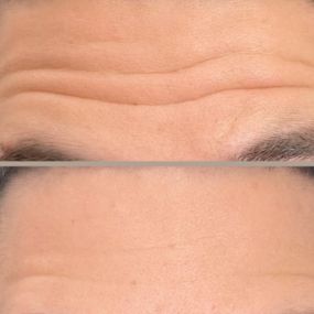 Botox for Forehead Wrinkles - Before and Afters by C10 Wellness and Rejuvenation in mIAMI