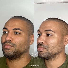 Jawline Filler and Botox done at C10 Wellness in Miami, FL