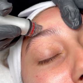 Microneedling Treatments at C10 Wellness and Rejuvenation in Miami, FL