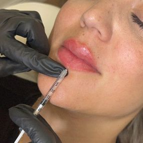 Lip Filler by C10 Wellness, a med spa in Miami, FL