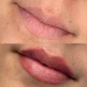 Lip Filler by C10 Wellness in Miami-Dade
