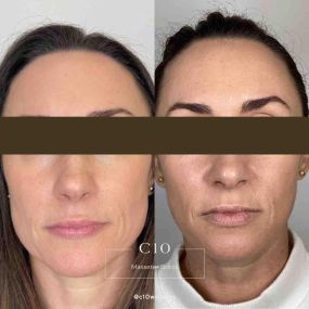 Masseter Botox done at C10 Wellness in Miami