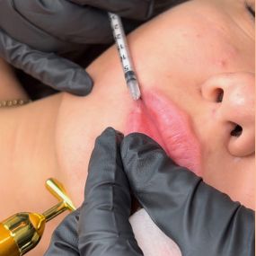 Lip Filler done at C10 Wellness in Miami, FL