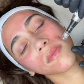 Microneedling at C10 Wellness in Miami, FL