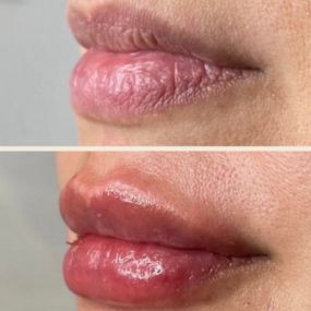 Lip Filler - Before and Afters by C10 Wellness and Rejuvenation in Miami