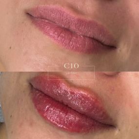 Lip Filler Before and After - C10 Wellness and Rejuvenation