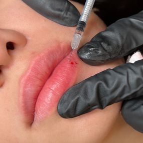 Lip Filler at C10 Wellness and Rejuvenation in Miami, FL