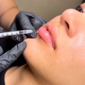 Lip Filler at C10 Wellness and Rejuvenation in Miami, FL