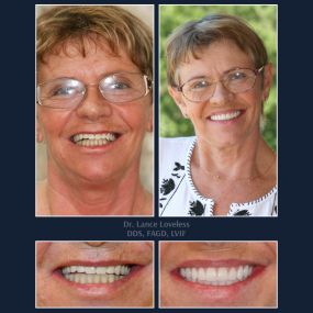 Smile Makeover Before & After

Dr. Lance Loveless, DDS, FAGD, LVIF
Dentist in Austin, TX
Bridgeview Dental
3801 N Capital of Texas Hwy J240, Austin, TX 78746
512‑347‑8299
https://www.bridgeviewdental.com

Cosmetic Dentistry, General Dentistry, & Restorative Dentistry