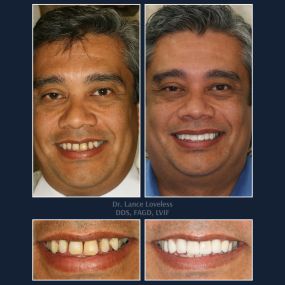 Smile Makeover Before & After

Dr. Lance Loveless, DDS, FAGD, LVIF
Dentist in Austin, TX
Bridgeview Dental
3801 N Capital of Texas Hwy J240, Austin, TX 78746
512‑347‑8299
https://www.bridgeviewdental.com

Cosmetic Dentistry, General Dentistry, & Restorative Dentistry