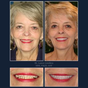 Smile Makeover Before & After

Dr. Lance Loveless, DDS, FAGD, LVIF
Dentist in Austin, TX
Bridgeview Dental
3801 N Capital of Texas Hwy J240, Austin, TX 78746
512‑347‑8299
https://www.bridgeviewdental.com

Cosmetic Dentistry, General Dentistry, & Restorative Dentistry