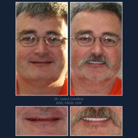 Smile Makeover Before & After

Dr. Lance Loveless, DDS, FAGD, LVIF
Dentist in Austin, TX
Bridgeview Dental
3801 N Capital of Texas Hwy J240, Austin, TX 78746
512‑347‑8299
https://www.bridgeviewdental.com

Cosmetic Dentistry, General Dentistry, & Restorative Dentistry