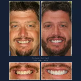 Smile Makeover Before & After

Dr. Lance Loveless, DDS, FAGD, LVIF
Dentist in Austin, TX
Bridgeview Dental
3801 N Capital of Texas Hwy J240, Austin, TX 78746
512‑347‑8299
https://www.bridgeviewdental.com

Cosmetic Dentistry, General Dentistry, & Restorative Dentistry