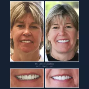 Smile Makeover Before & After

Dr. Lance Loveless, DDS, FAGD, LVIF
Dentist in Austin, TX
Bridgeview Dental
3801 N Capital of Texas Hwy J240, Austin, TX 78746
512‑347‑8299
https://www.bridgeviewdental.com

Cosmetic Dentistry, General Dentistry, & Restorative Dentistry