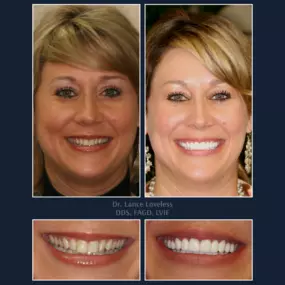 Smile Makeover Before & After

Dr. Lance Loveless, DDS, FAGD, LVIF
Dentist in Austin, TX
Bridgeview Dental
3801 N Capital of Texas Hwy J240, Austin, TX 78746
512‑347‑8299
https://www.bridgeviewdental.com

Cosmetic Dentistry, General Dentistry, & Restorative Dentistry