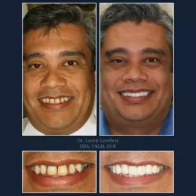 Smile Makeover Before & After

Dr. Lance Loveless, DDS, FAGD, LVIF
Dentist in Austin, TX
Bridgeview Dental
3801 N Capital of Texas Hwy J240, Austin, TX 78746
512‑347‑8299
https://www.bridgeviewdental.com

Cosmetic Dentistry, General Dentistry, & Restorative Dentistry