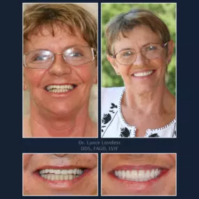 Smile Makeover Before & After

Dr. Lance Loveless, DDS, FAGD, LVIF
Dentist in Austin, TX
Bridgeview Dental
3801 N Capital of Texas Hwy J240, Austin, TX 78746
512‑347‑8299
https://www.bridgeviewdental.com

Cosmetic Dentistry, General Dentistry, & Restorative Dentistry