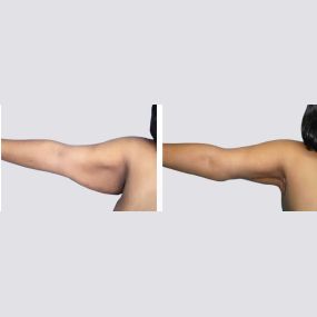 Arm Lift Before and After