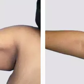 Arm Lift Before and After