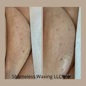 Unleash your confidence and embrace the allure of smooth skin with Shameless Waxing LLC's premier bikini waxing services in Colorado Springs! Our experienced estheticians specialize in delivering precise and comfortable waxing treatments, ensuring a flawless bikini line that leaves you feeling empowered and ready for any occasion. Whether you prefer a classic bikini wax or a daring Brazilian, we cater to your preferences with discretion and professionalism. Say goodbye to razors and hello to lon