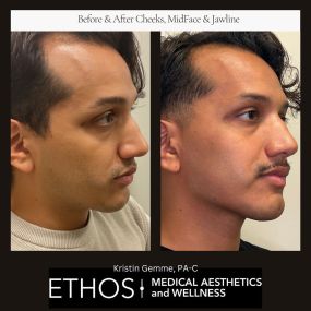 Achieve sculpted and defined cheeks with our cheek filler treatments at Ethos Medical Aesthetics & Wellness. Our experienced team uses advanced techniques to provide natural-looking results that enhance your facial contours, allowing you to radiate confidence.