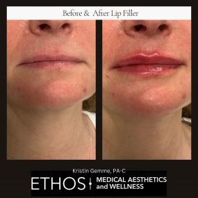 Enhance your natural beauty with lip fillers at Ethos Medical Aesthetics & Wellness. Our skilled practitioners use lip fillers to create subtle, balanced, and beautifully shaped lips tailored to your desires, providing a boost of confidence and allure.