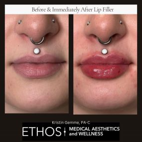 Enhance your natural beauty with lip fillers at Ethos Medical Aesthetics & Wellness. Our skilled practitioners use lip fillers to create subtle, balanced, and beautifully shaped lips tailored to your desires, providing a boost of confidence and allure.