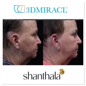 3DMIRACL at ShanthalaMD