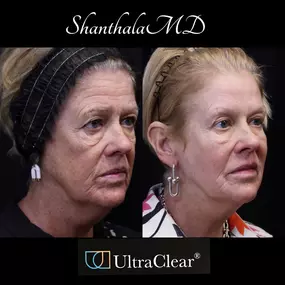 UltraClear Laser by Dr. Shanthala