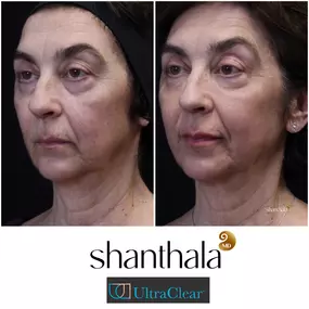 Full Face Rejuvenation with LaserCoring Boston
