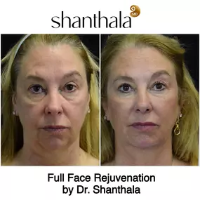 Non Surgical Facelift at ShanthalaMD