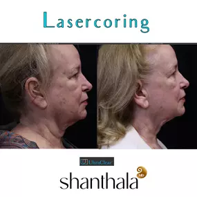 LaserCoring MD Boston 
Dr. Shanthala