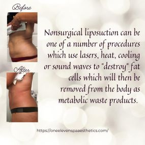 Nonsurgical liposuction can one of a number of procedures which use lasers. heat, Cooling or sound waves to 