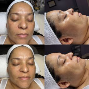 Microneedling