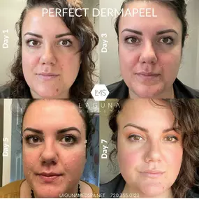 Perfect dermapeel