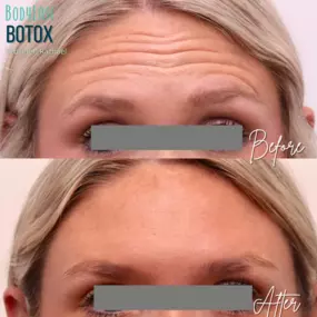 Botox Before and After