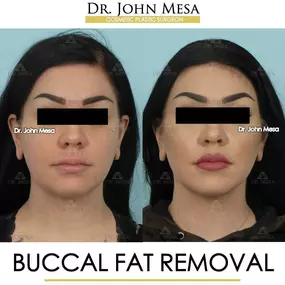 Bild von Dr. John Mesa, MD: Plastic Surgeon NYC, Buccal Fat Removal, Chin Liposuction, Facelift, Facial Masculinization, Chin Implant