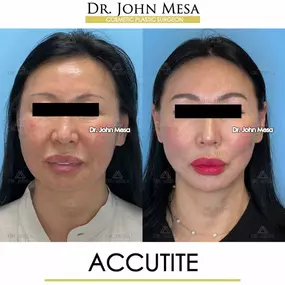 Bild von Dr. John Mesa, MD: Plastic Surgeon NYC, Buccal Fat Removal, Chin Liposuction, Facelift, Facial Masculinization, Chin Implant