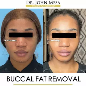 Bild von Dr. John Mesa, MD: Plastic Surgeon NYC, Buccal Fat Removal, Chin Liposuction, Facelift, Facial Masculinization, Chin Implant