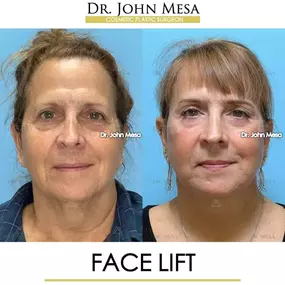 Bild von Dr. John Mesa, MD: Plastic Surgeon NYC, Buccal Fat Removal, Chin Liposuction, Facelift, Facial Masculinization, Chin Implant